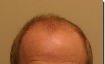 Hair restoration procedure results