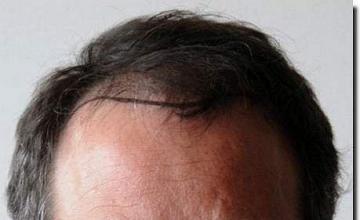 Hair restoration procedure results