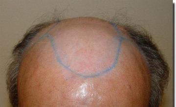 Hair restoration procedure results