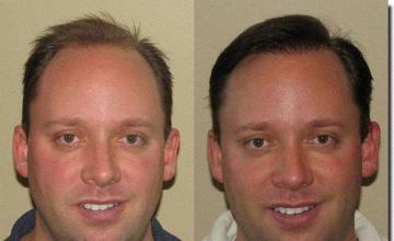 Hair restoration procedure results