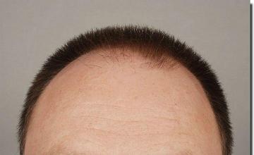 Hair restoration procedure results