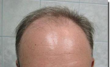 Hair restoration procedure results