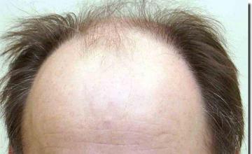 Hair restoration procedure results