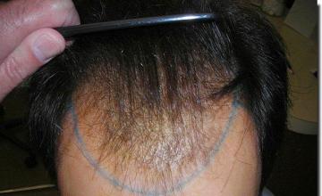 Hair restoration procedure results