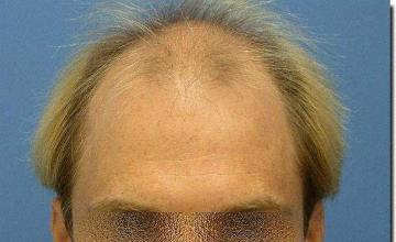 Hair restoration procedure results