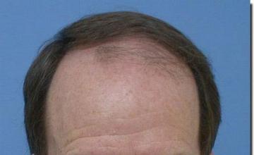 Hair restoration procedure results