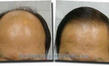 Hair restoration procedure results