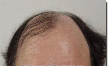 Hair restoration procedure results