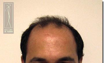 Hair restoration procedure results