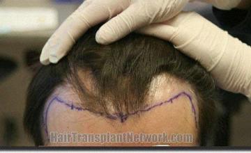 Hair restoration procedure results