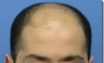 Hair restoration procedure results