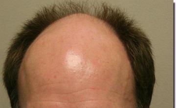 Hair restoration procedure results