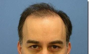 Hair restoration procedure results