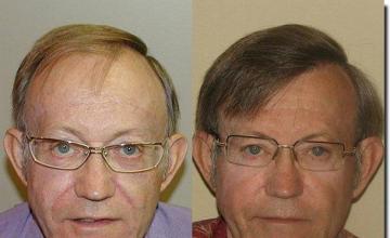 Hair restoration procedure results