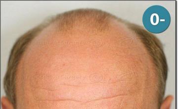 Hair restoration procedure results