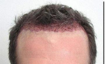 Hair restoration procedure results