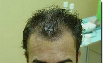 Hair restoration procedure results