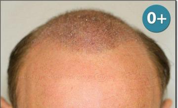 Hair restoration procedure results