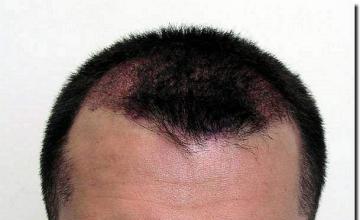 Hair restoration procedure results