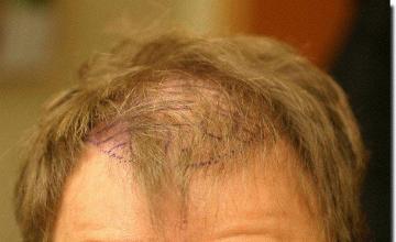 Hair restoration procedure results