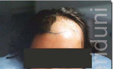 Hair restoration procedure results