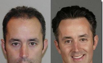 Hair restoration procedure results