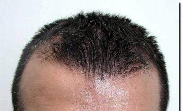 Hair restoration procedure results