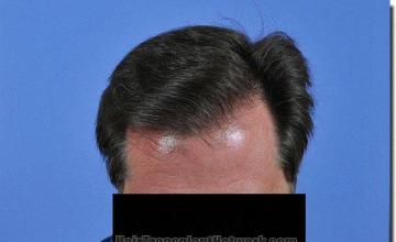 Hair restoration procedure results