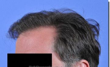 Hair restoration procedure results