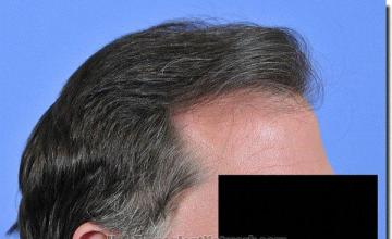 Hair restoration procedure results