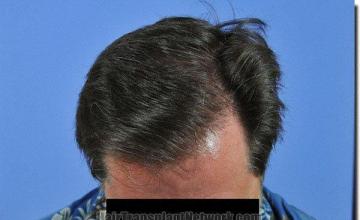 Hair restoration procedure results