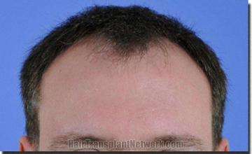 Hair restoration procedure results