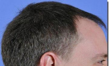 Hair restoration procedure results