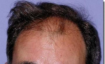 Hair restoration procedure results