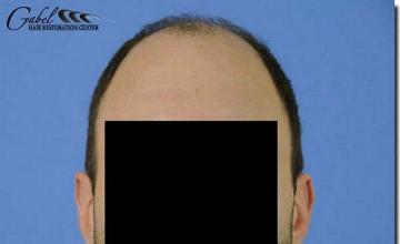 Hair restoration procedure results