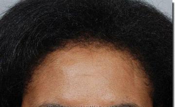 Hair restoration procedure results