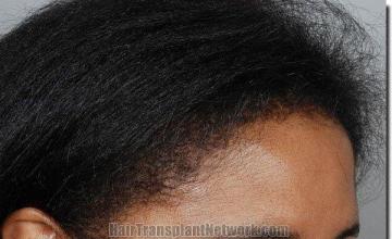 Hair restoration procedure results