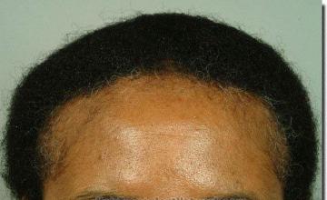 Hair restoration procedure results