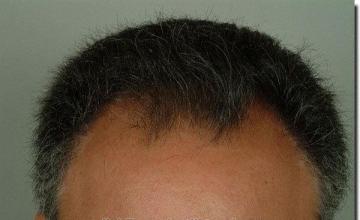 Hair restoration procedure results