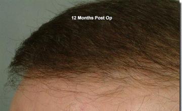 Hair restoration procedure results