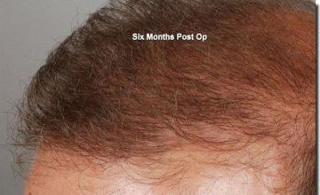 Hair restoration procedure results