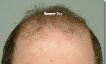 Hair restoration procedure results