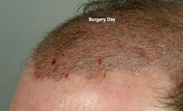 Hair restoration procedure results