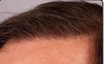 Hair restoration procedure results