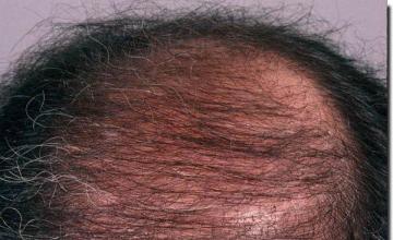 Hair restoration procedure results