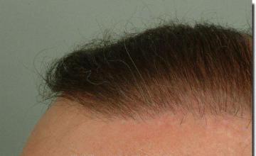 Hair restoration procedure results