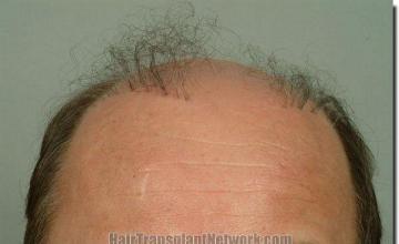 Hair restoration procedure results