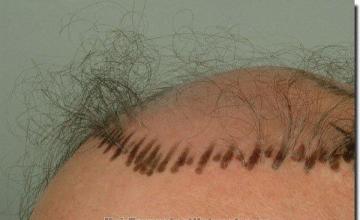 Hair restoration procedure results