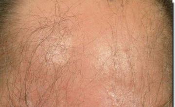 Hair restoration procedure results