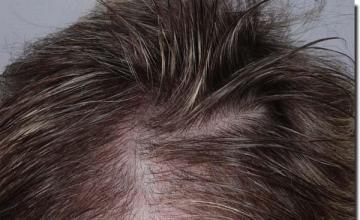 Hair restoration procedure results